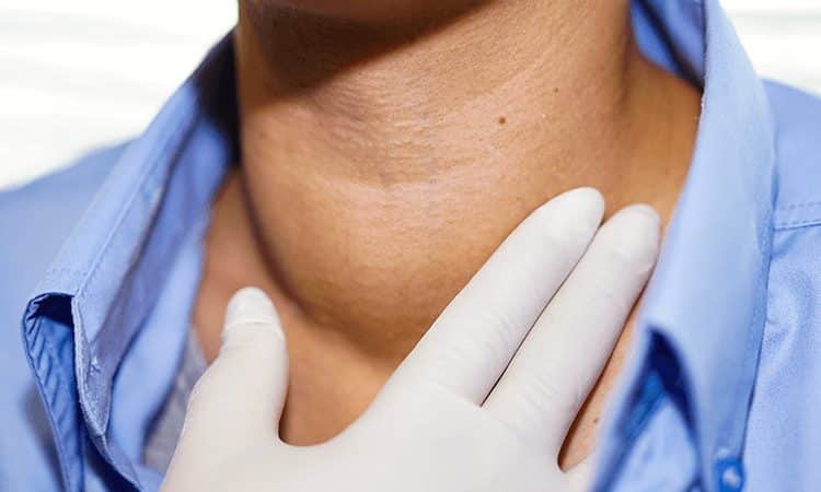 Tratamiento natural para la tiroiditis de Hashimoto